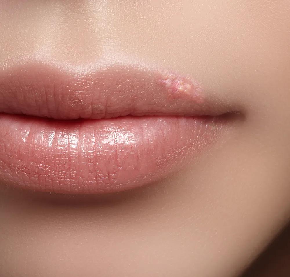 Herpes labial recorrente com pequenas bolhas no lábio